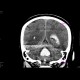 Intracerebral hemorhage, hemocephalus, tamponaded fourth ventricle: CT - Computed tomography